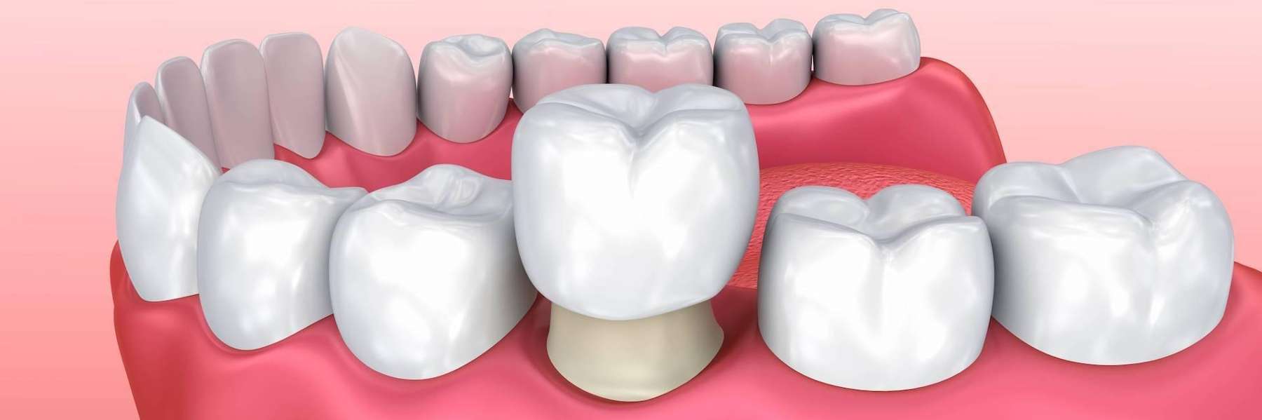 illustration of dental crown placed on tooth