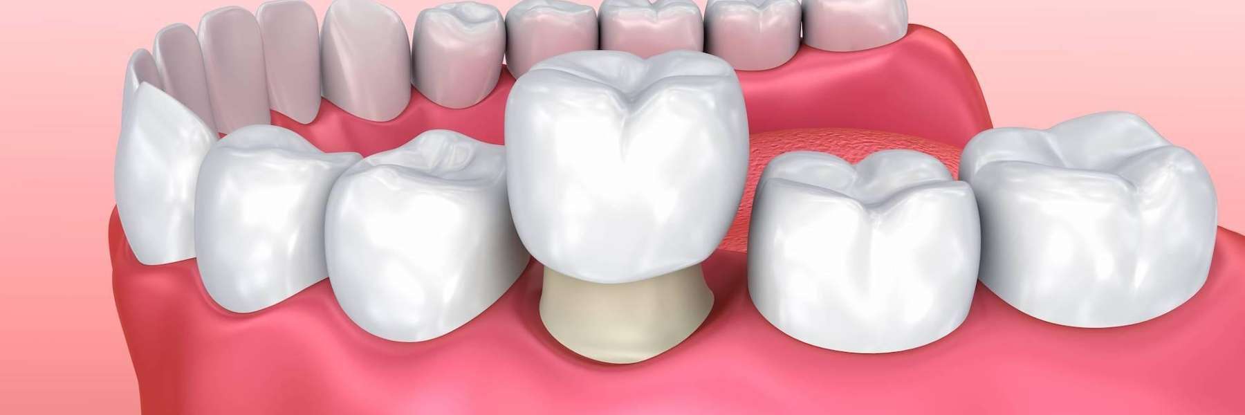 tooth crown | best dentist tampa