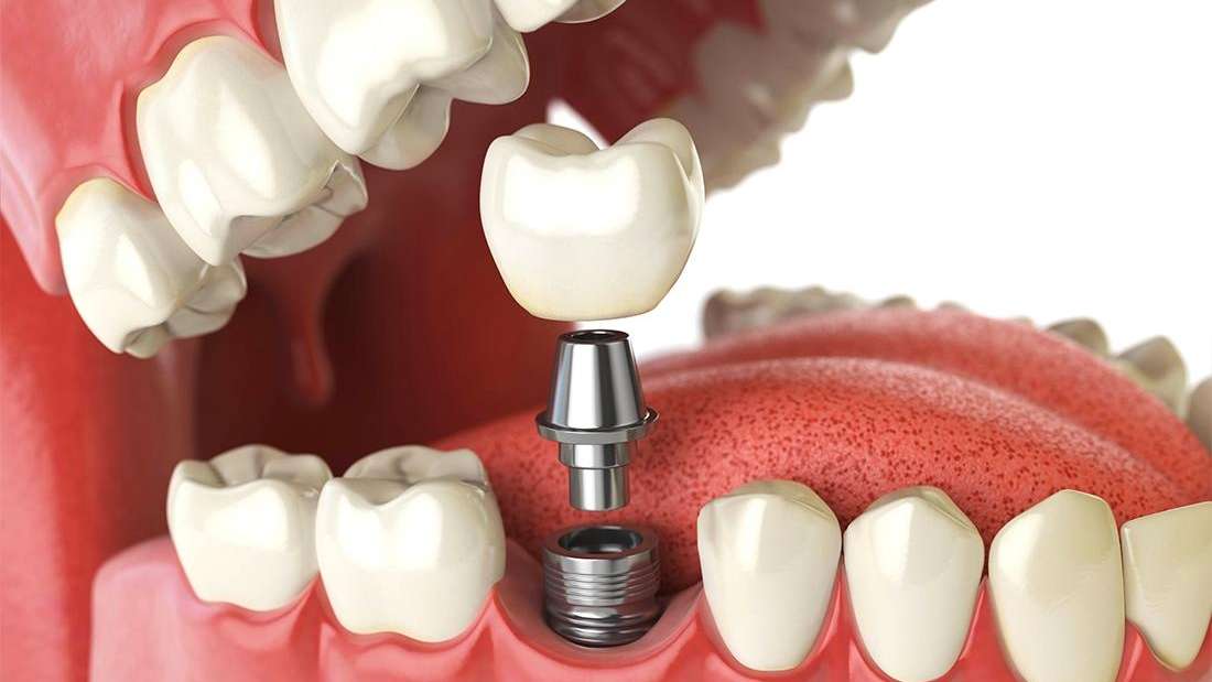 Tampa Implant Dentist Blog The Process for Dental Implants